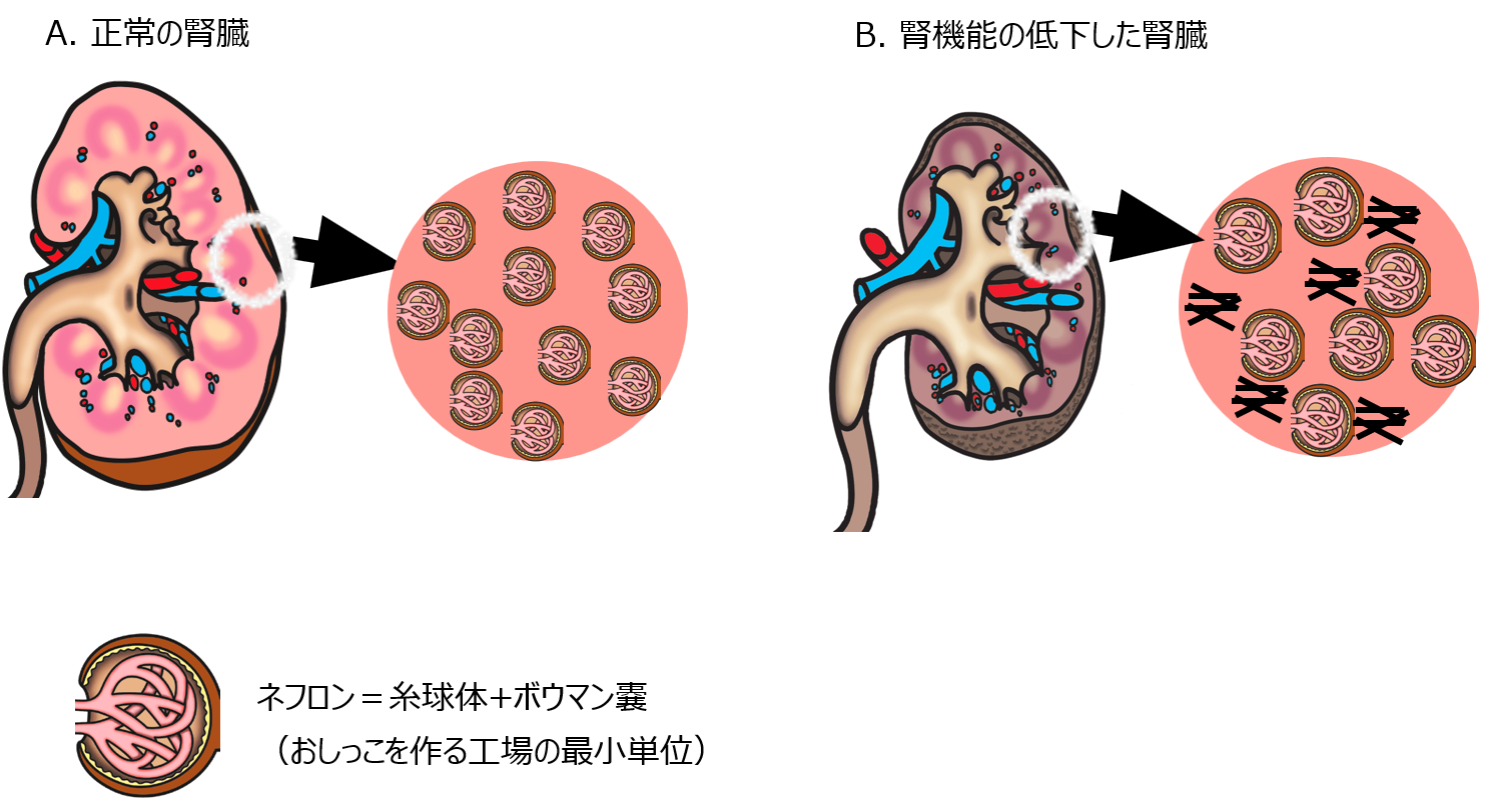A.正常の腎臓、B.腎機能の低下した腎臓